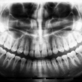 Root Canal Treatment